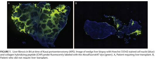 CHPs’ can Help Predict Liver Survival in Biliary Atresia