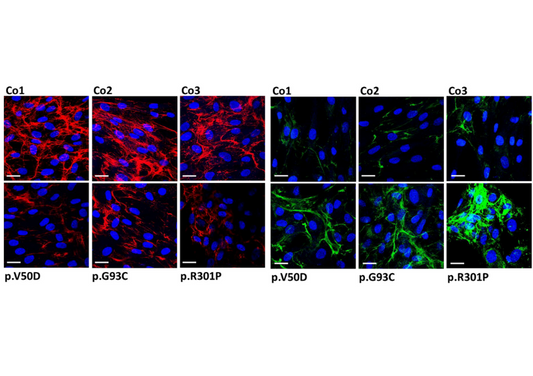 Collagen Hybridizing Peptide Detects Excess Collagen Degradation in Periodontal Ehlers-Danlos Syndrome Fibroblasts